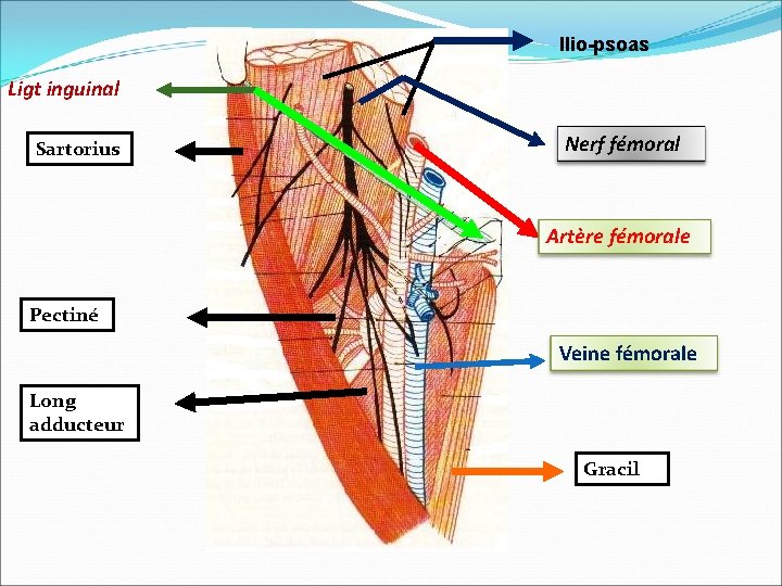Ilio-psoas Ligt inguinal Sartorius Nerf fémoral Artère fémorale Pectiné Veine fémorale Long adducteur Gracil