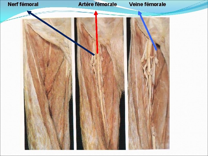 Nerf fémoral Artère fémorale Veine fémorale 