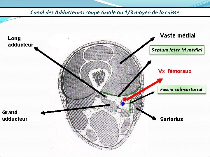 Canal des Adducteurs: coupe axiale au 1/3 moyen de la cuisse Long adducteur Vaste