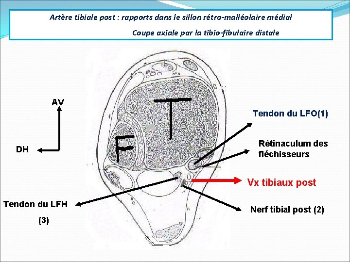 Artère tibiale post : rapports dans le sillon rétro-malléolaire médial Coupe axiale par la