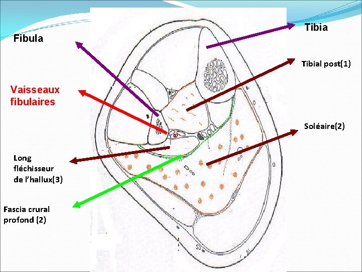 Tibia Fibula Tibial post(1) Vaisseaux fibulaires Soléaire(2) Long fléchisseur de l’hallux(3) Fascia crural profond