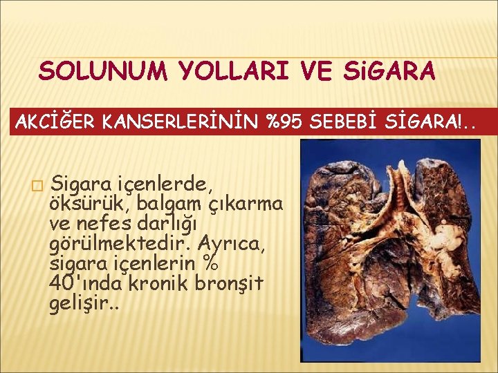 SOLUNUM YOLLARI VE Si. GARA AKCİĞER KANSERLERİNİN %95 SEBEBİ SİGARA!. . � Sigara içenlerde,