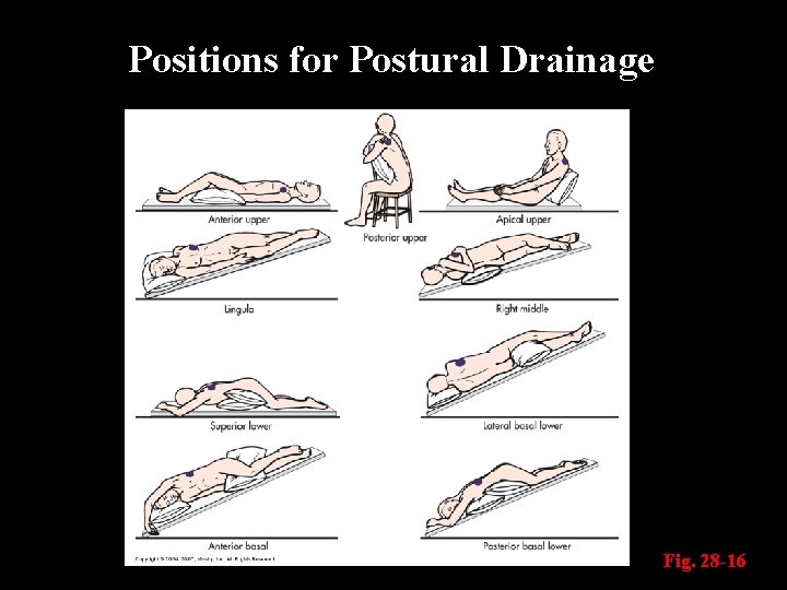 Positions for Postural Drainage Fig. 28 -16 