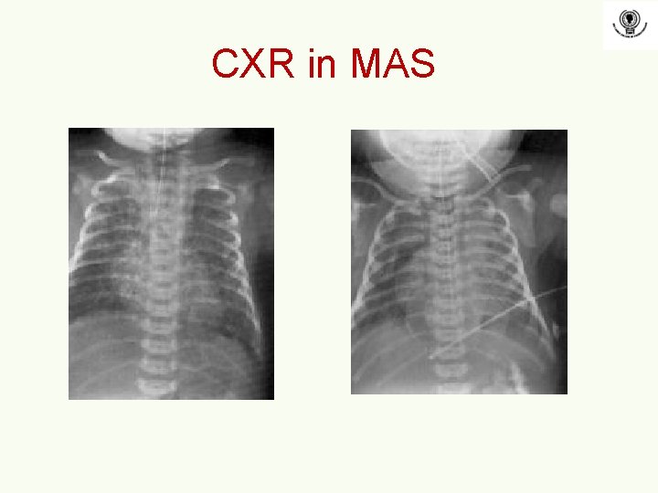 CXR in MAS CXR in MAS