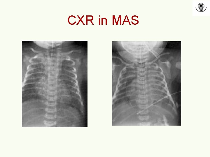 CXR in MAS 