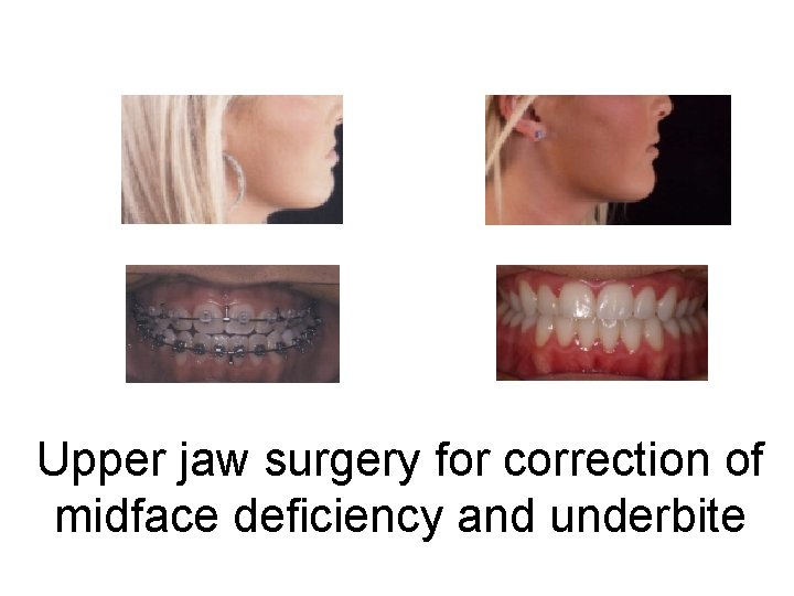 Upper jaw surgery for correction of midface deficiency and underbite 