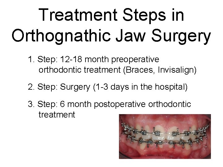 Treatment Steps in Orthognathic Jaw Surgery 1. Step: 12 -18 month preoperative orthodontic treatment