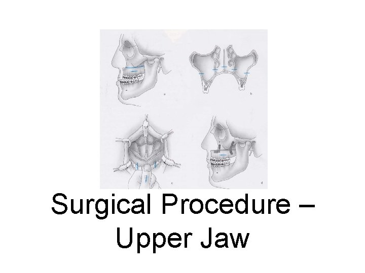 Surgical Procedure – Upper Jaw 
