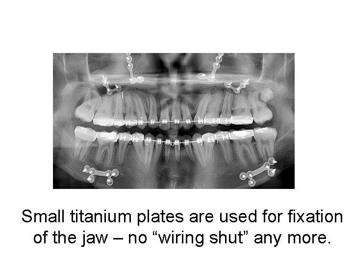 Small titanium plates are used for fixation of the jaw – no “wiring shut”