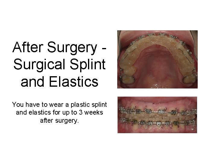 After Surgery Surgical Splint and Elastics You have to wear a plastic splint and