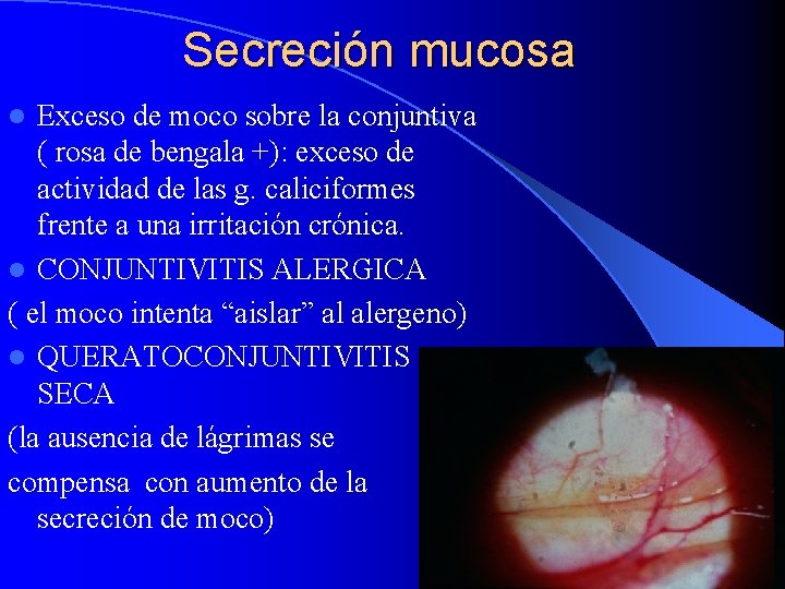 Secreción mucosa Exceso de moco sobre la conjuntiva ( rosa de bengala +): exceso