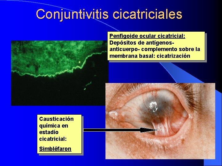 Conjuntivitis cicatriciales Penfigoide ocular cicatricial: Depósitos de antígenosanticuerpo- complemento sobre la membrana basal: cicatrización