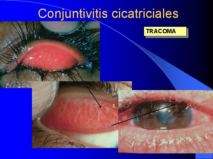 Conjuntivitis cicatriciales TRACOMA 