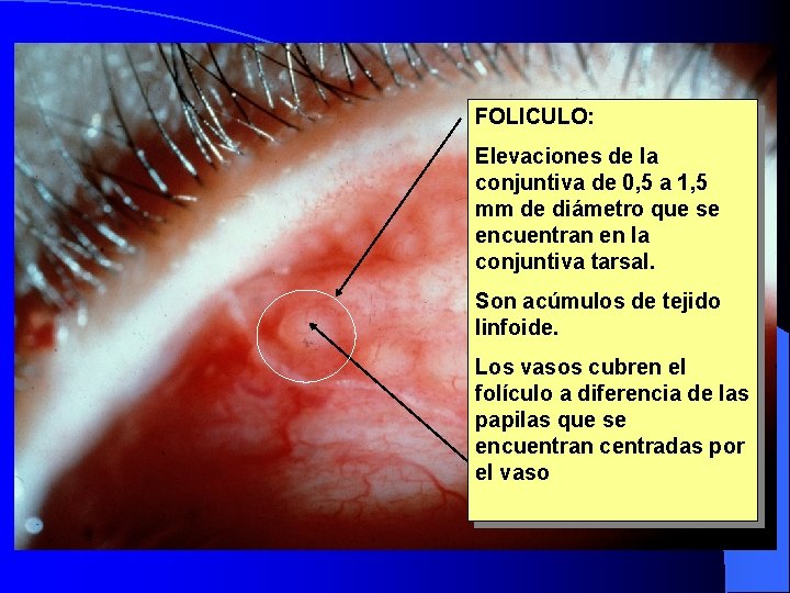 Folículos. FOLICULO: l Pequeñas Elevaciones de la conjuntiva de 0, 5 a 1, 5