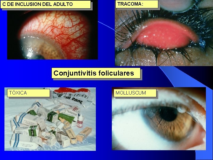 C DE INCLUSION DEL ADULTO TRACOMA: Conjuntivitis foliculares TÓXICA MOLLUSCUM 