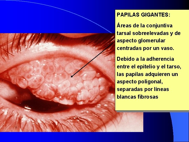 PAPILAS GIGANTES: Áreas de la conjuntiva tarsal sobreelevadas y de aspecto glomerular centradas por