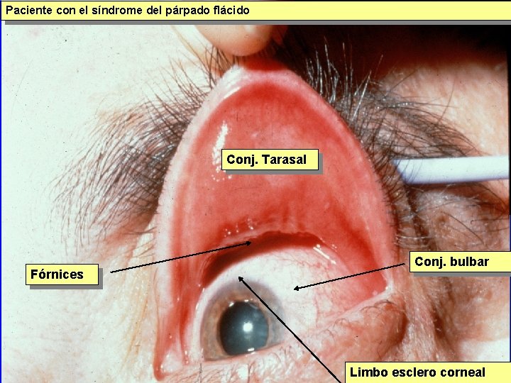 Paciente con el síndrome del párpado flácido Conj. Tarasal Fórnices Conj. bulbar Limbo esclero