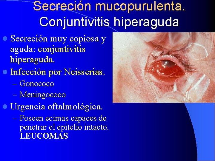 Secreción mucopurulenta. Conjuntivitis hiperaguda l Secreción muy copiosa y aguda: conjuntivitis hiperaguda. l Infección