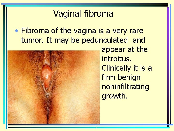 Vaginal fibroma • Fibroma of the vagina is a very rare tumor. It may