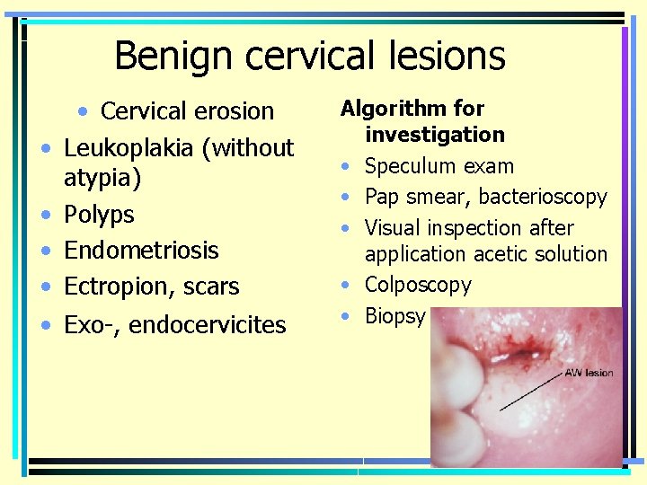 Benign cervical lesions • • • Cervical erosion Leukoplakia (without atypia) Polyps Endometriosis Ectropion,