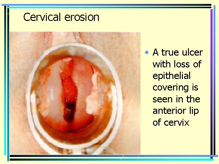 Cervical erosion • A true ulcer with loss of epithelial covering is seen in