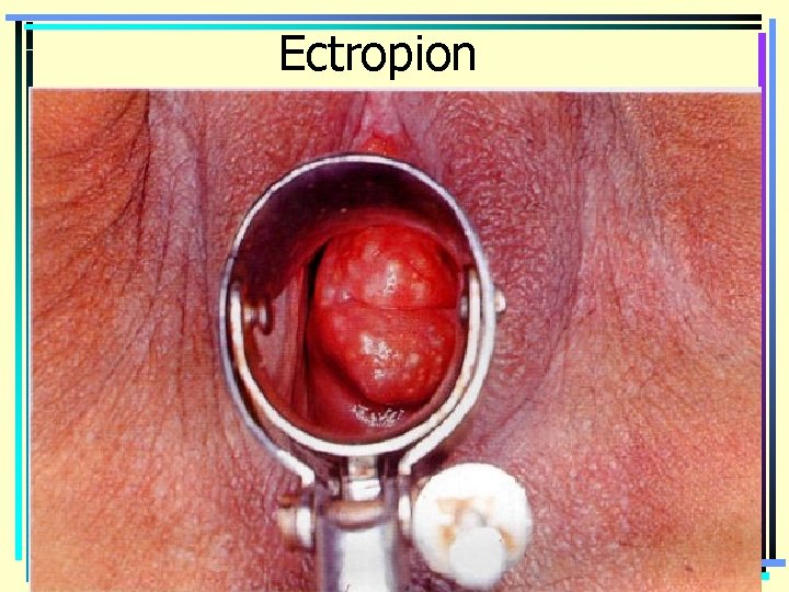 Ectropion 