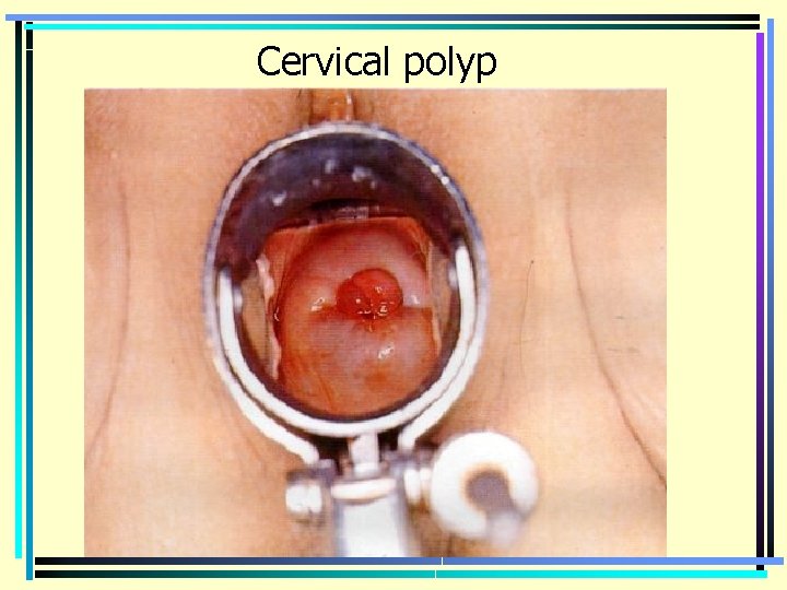 Cervical polyp 