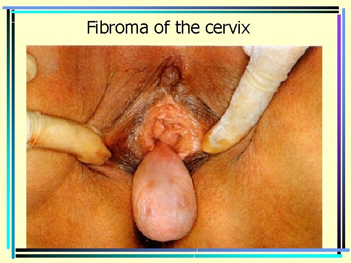 Fibroma of the cervix 