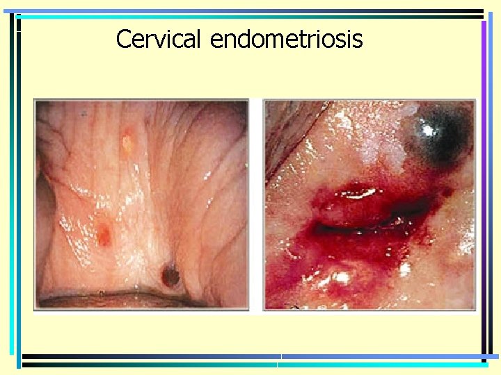 Cervical endometriosis 