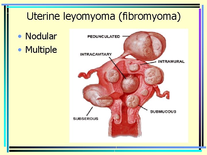 Uterine leyomyoma (fibromyoma) • Nodular • Multiple 