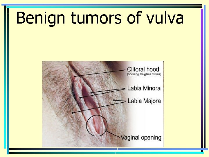 Benign tumors of vulva 