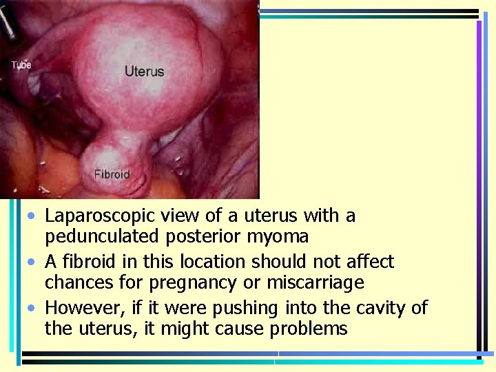  • Laparoscopic view of a uterus with a pedunculated posterior myoma • A