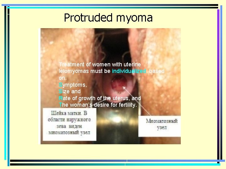 Protruded myoma Treatment of women with uterine leiomyomas must be individualized, based on: Symptoms,