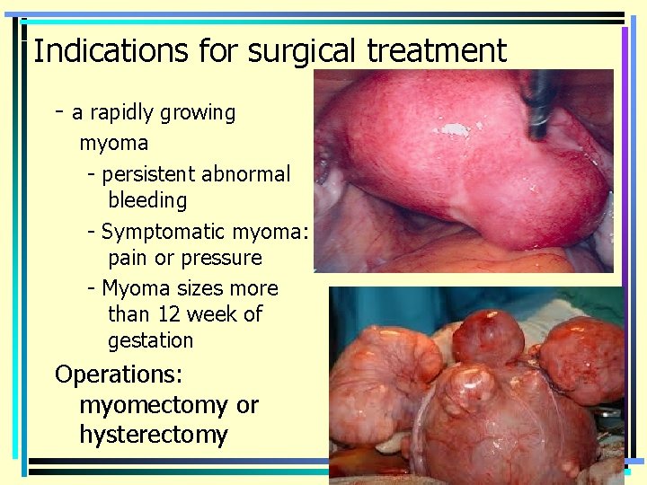 Indications for surgical treatment - a rapidly growing myoma - persistent abnormal bleeding -