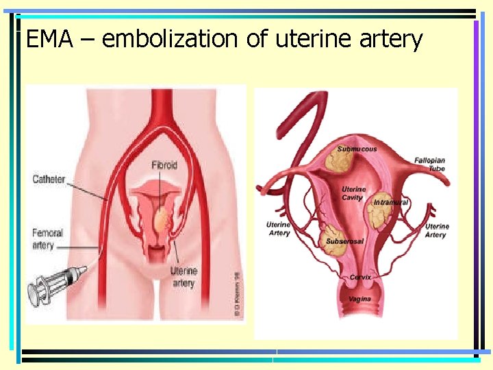 EMA – embolization of uterine artery 