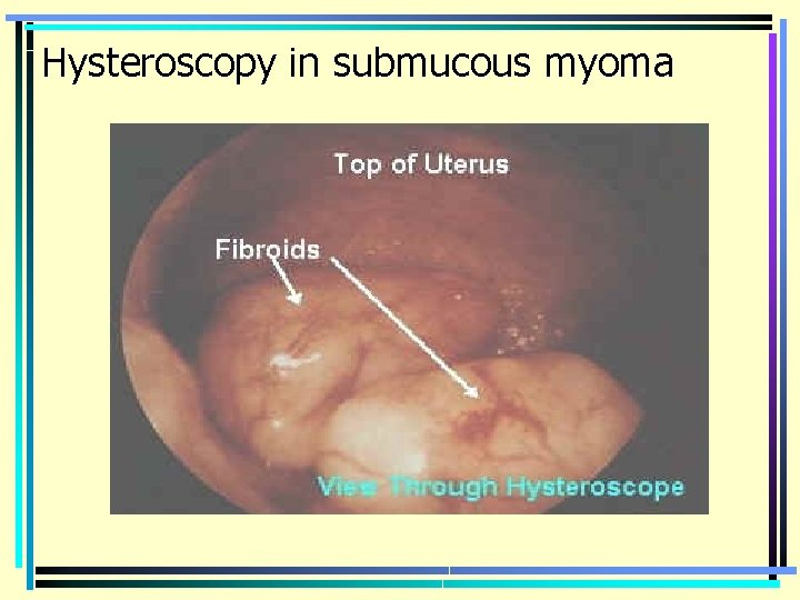 Hysteroscopy in submucous myoma 