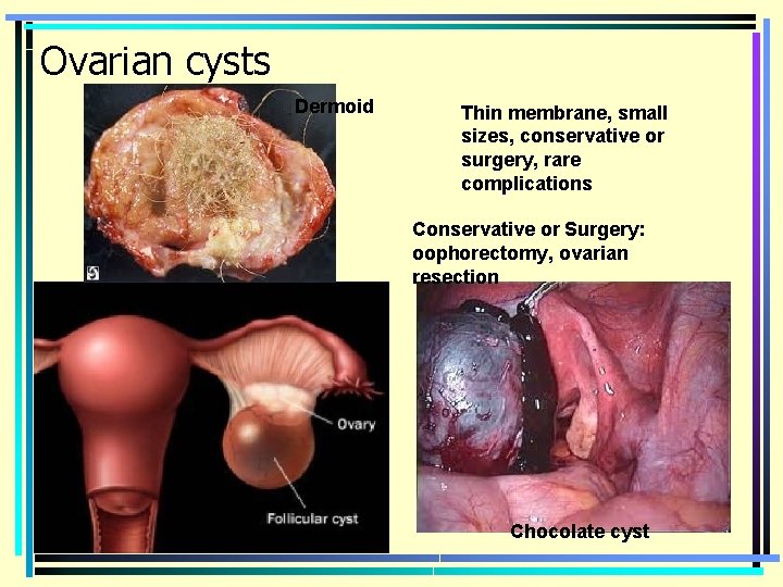 Ovarian cysts Dermoid Thin membrane, small sizes, conservative or surgery, rare complications Conservative or