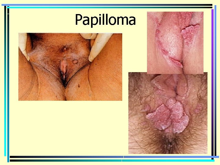 Papilloma 