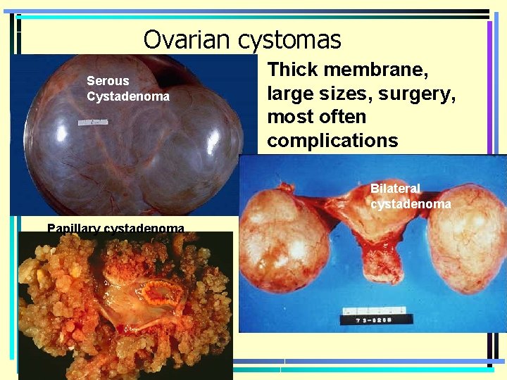 Ovarian cystomas Serous Cystadenoma Thick membrane, large sizes, surgery, most often complications Bilateral cystadenoma