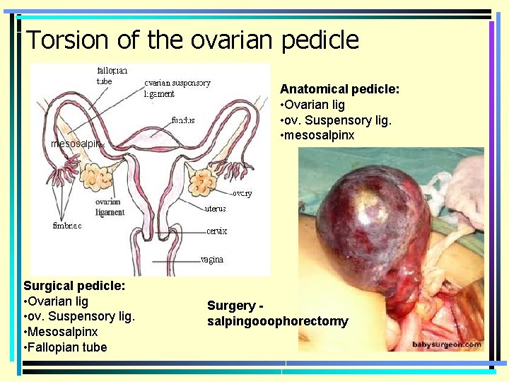 Torsion of the ovarian pedicle mesosalpinx Surgical pedicle: • Ovarian lig • ov. Suspensory