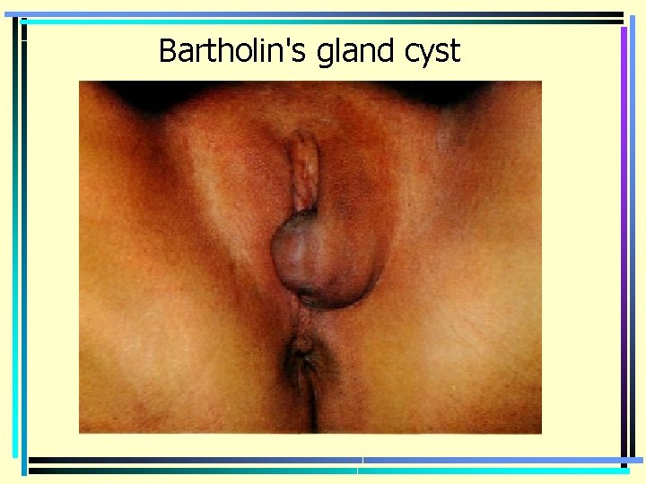 Bartholin's gland cyst 