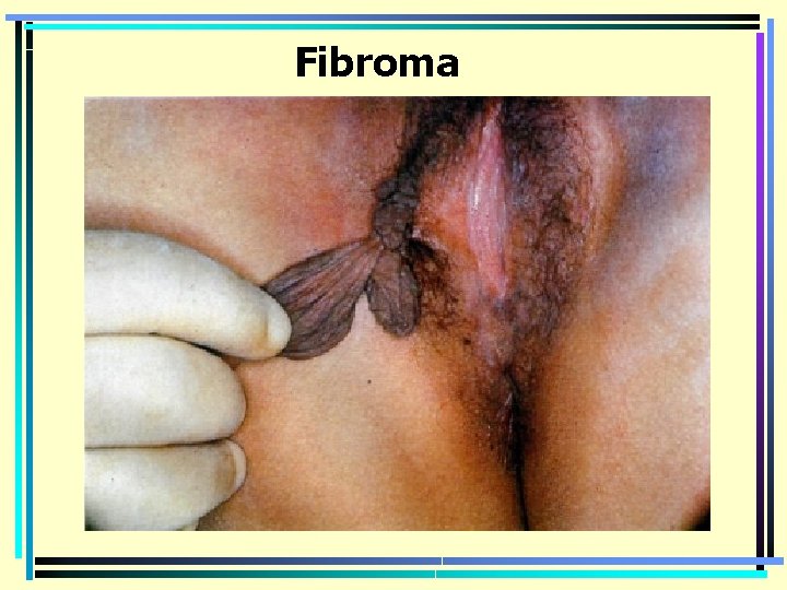 Fibroma 