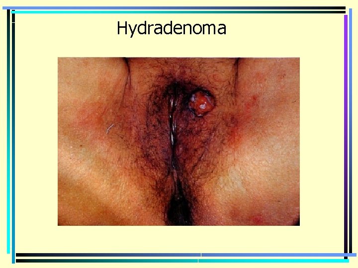 Hydradenoma 