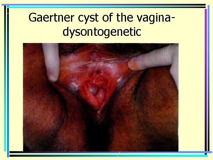 Gaertner cyst of the vaginadysontogenetic 