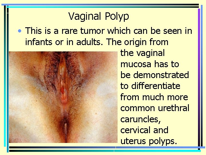 Vaginal Polyp • This is a rare tumor which can be seen in infants