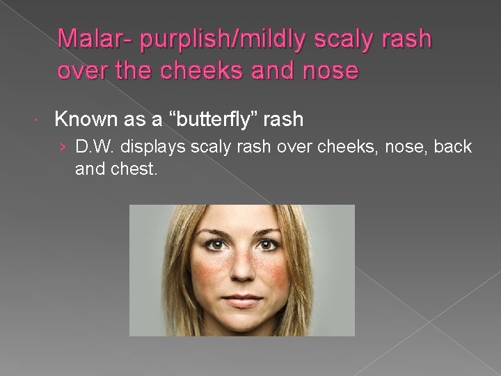 Malar- purplish/mildly scaly rash over the cheeks and nose Known as a “butterfly” rash