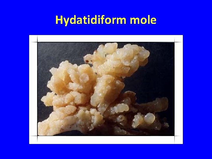 Hydatidiform mole 