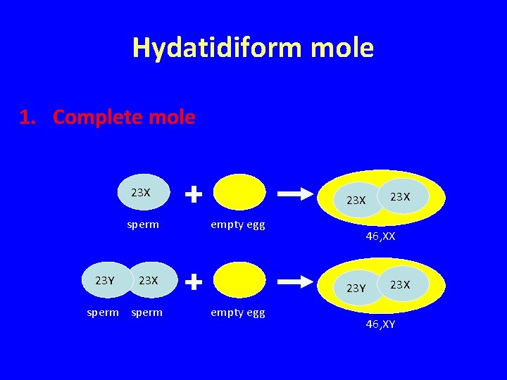 Hydatidiform mole 1. Complete mole 23 X sperm 23 Y 23 X empty egg