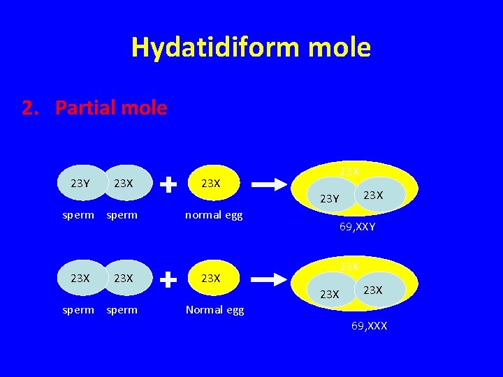 Hydatidiform mole 2. Partial mole 23 Y 23 X 23 X 23 Y sperm