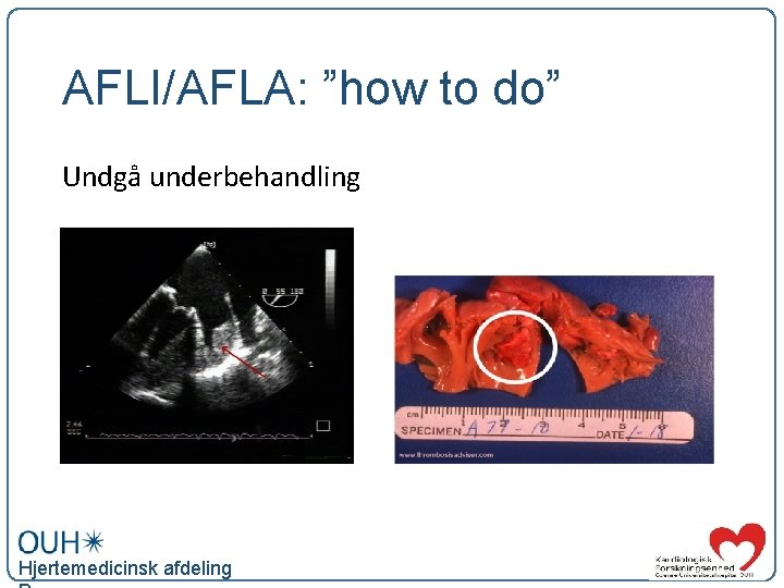 AFLI/AFLA: ”how to do” Undgå underbehandling Hjertemedicinsk afdeling 